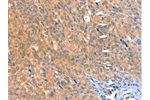 The image on the left is immunohistochemistry of paraffin-embedded Human cervical cancer tissue using ABIN7128174(ACOX3 Antibody) at dilution 1/25, on the right is treated with fusion protein. (ACOX3 Antikörper)