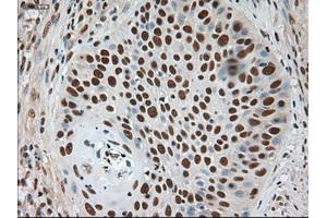 Immunohistochemical staining of paraffin-embedded Adenocarcinoma of breast using anti-Notch1 (ABIN2452671) mouse monoclonal antibody. (Notch1 Antikörper  (AA 2300-2556))