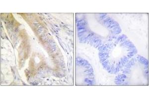 Immunohistochemistry analysis of paraffin-embedded human colon carcinoma tissue, using IREB1 (Ab-138) Antibody. (Aconitase 1 Antikörper  (AA 106-155))