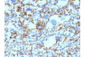 Formalin-fixed, paraffin-embedded human Histiocytoma stained with HLA-DR Monoclonal Antibody (SPM423).