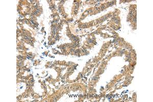 Immunohistochemistry of Human liver cancer using KCNG3 Polyclonal Antibody at dilution of 1:40 (KCNG3 Antikörper)