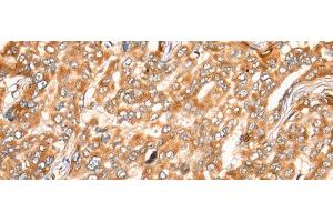 Immunohistochemistry of paraffin-embedded Human liver cancer tissue using ZMYND10 Polyclonal Antibody at dilution of 1:35(x200) (ZMYND10 Antikörper)