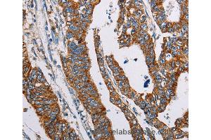 Immunohistochemistry of Human lung cancer using ALG2 Polyclonal Antibody at dilution of 1:35 (ALG2 Antikörper)