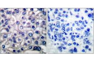 Immunohistochemistry analysis of paraffin-embedded human breast carcinoma tissue, using EGFR (Ab-693) Antibody. (EGFR Antikörper  (AA 661-710))