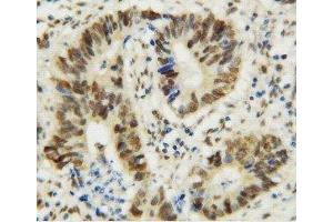 Anti-MTA1 antibody, IHC(P) IHC(P): Human Rectal Cancer Tissue