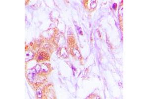 Immunohistochemical analysis of CDKL4 staining in human lung cancer formalin fixed paraffin embedded tissue section. (CDKL4 Antikörper  (C-Term))
