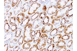 Formalin-fixed, paraffin-embedded human Renal Cell Carcinoma stained with Laminin Rat Monoclonal Antibody (A5).