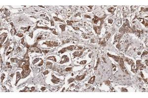 IHC-P Image Immunohistochemical analysis of paraffin-embedded human breast cancer, using Growth Hormone, antibody at 1:100 dilution. (Growth Hormone 1 Antikörper)
