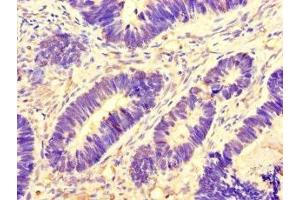 Immunohistochemistry of paraffin-embedded human ovarian cancer using ABIN7145075 at dilution of 1:100 (Aurora A Antikörper  (AA 1-131))