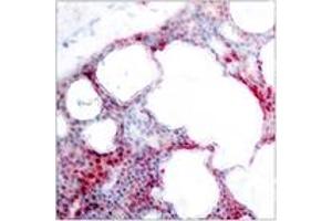 Immunohistochemistry analysis of paraffin-embedded human breast carcinoma, using ATF2 (Phospho-Ser62 or 44) Antibody. (ATF2 Antikörper  (pSer62))