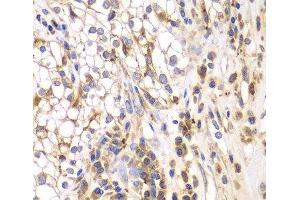 Immunohistochemistry of paraffin-embedded Human kidney cancer using SRPK1 Polyclonal Antibody at dilution of 1:200 (40x lens).