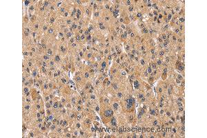Immunohistochemistry of Human liver cancer using PPIF Polyclonal Antibody at dilution of 1:60 (PPIF Antikörper)
