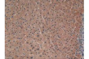 IHC-P analysis of Human Liver Cancer Tissue, with DAB staining. (ADCY3 Antikörper  (AA 501-736))