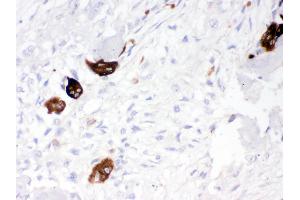Cathepsin K was detected in paraffin-embedded sections of human osteosarcoma tissues using rabbit anti- Cathepsin K Antigen Affinity purified polyclonal antibody at 1 μg/mL. (Cathepsin K Antikörper  (AA 115-329))