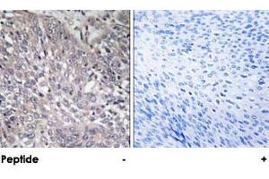 Immunohistochemical analysis of paraffin-embedded human cervix carcinoma tissue using ITPR1 polyclonal antibody . (ITPR1 Antikörper)