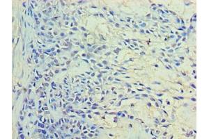 Immunohistochemistry of paraffin-embedded human breast cancer using ABIN7167221 at dilution of 1:100 (RAB11A Antikörper  (AA 2-213))