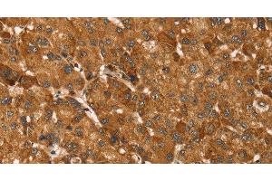 Immunohistochemistry of paraffin-embedded Human liver cancer tissue using TBC1D1 Polyclonal Antibody at dilution 1:45 (TBC1D1 Antikörper)