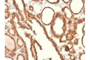 Formalin-fixed, paraffin-embedded human Thyroid Carcinoma stained with EpCAM Rabbit Recombinant Monoclonal Antibody (EGP40/2041R). (Rekombinanter EpCAM Antikörper  (Extracellular Domain))