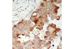 Immunohistochemical analysis of POTEB staining in human prostate cancer formalin fixed paraffin embedded tissue section. (POTEB Antikörper  (C-Term))