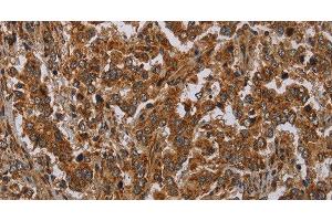 Immunohistochemistry of paraffin-embedded Human liver cancer tissue using ATP2A1 Polyclonal Antibody at dilution 1:30 (ATP2A1/SERCA1 Antikörper)