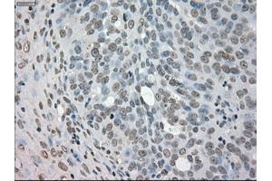 Immunohistochemical staining of paraffin-embedded Adenocarcinoma of colon tissue using anti-NEK6mouse monoclonal antibody. (NEK6 Antikörper)