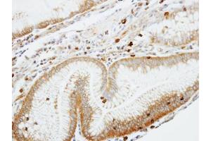 IHC-P Image Immunohistochemical analysis of paraffin-embedded human gastric cancer, using Coronin 1A, antibody at 1:100 dilution. (Coronin 1a Antikörper  (C-Term))