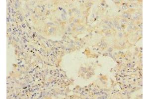 Immunohistochemistry of paraffin-embedded human lung cancer using ABIN7154845 at dilution of 1:100 (HAND1 Antikörper  (AA 16-215))