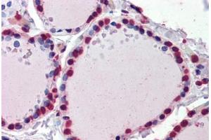 Human Thyroid (formalin-fixed, paraffin-embedded) stained with  antibody ABIN462276 followed by biotinylated secondary antibody, alkaline phosphatase-streptavidin and chromogen. (CRABP1 Antikörper  (AA 1-137))