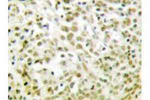 Immunohistochemistry analyzes of p53 antibody in paraffin-embedded human lung carcinoma tissue. (p53 Antikörper)