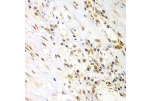 Immunohistochemistry of paraffin-embedded human gastric cancer using LHX4 antibody (ABIN5975324) at dilution of 1/100 (40x lens). (LHX4 Antikörper)