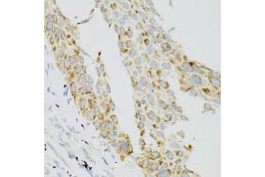 Immunohistochemistry of paraffin-embedded human lung cancer using TEK antibody. (TEK Antikörper)