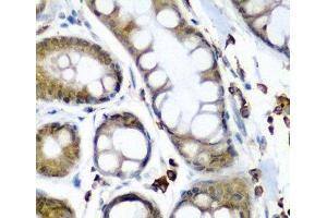 Immunohistochemistry of paraffin-embedded Human colon carcinoma using SECISBP2 Polyclonal Antibody at dilution of 1:200 (40x lens).
