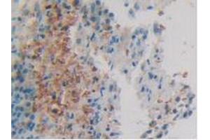 IHC-P analysis of Human Skin Cancer Tissue, with DAB staining. (Calretinin Antikörper  (AA 28-248))