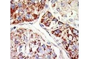 IHC analysis of FFPE human hepatocarcinoma tissue stained with the EZH1 antibody (EZH1 Antikörper  (AA 393-422))