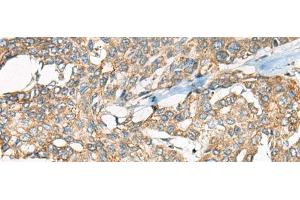 Immunohistochemistry of paraffin-embedded Human liver cancer tissue using YEATS2 Polyclonal Antibody at dilution of 1:55(x200) (YEATS2 Antikörper)