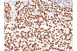 Formalin-fixed, paraffin-embedded human Breast Carcinoma stained with Progesterone Receptor Mouse Monoclonal Antibody (PR484). (Progesterone Receptor Antikörper)