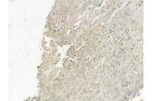 ABIN6262103 and ABIN6277371 at 1/100 staining human lung squamous cell carcinoma by IHC-P. (GRPR Antikörper  (Internal Region))