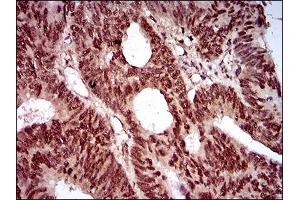 Immunohistochemical analysis of paraffin-embedded rectum cancer tissues using NBN mouse mAb with DAB staining. (Nibrin Antikörper  (AA 467-615))