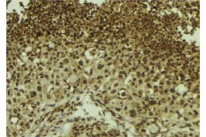ABIN6278705 at 1/100 staining Human breast cancer tissue by IHC-P. (ZNF7 Antikörper  (Internal Region))