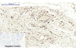 Immunohistochemical analysis of paraffin-embedded human breast tissue. (PTGS2 Antikörper  (AA 530-610))