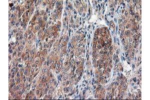 Immunohistochemical staining of paraffin-embedded Carcinoma of Human liver tissue using anti-CAPN9 mouse monoclonal antibody. (Calpain 9 Antikörper)