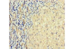 Immunohistochemistry of paraffin-embedded human liver cancer using ABIN7171548 at dilution of 1:100 (TAS2R41 Antikörper  (AA 205-234))