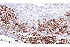 IHC-P Image Immunohistochemical analysis of paraffin-embedded human ovarian cancer, using FLRT1, antibody at 1:100 dilution.