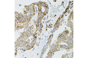 Immunohistochemistry of paraffin-embedded human liver cancer using SIRT3 antibody (ABIN5973348) at dilution of 1/100 (40x lens).
