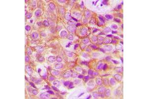 Immunohistochemical analysis of EGFR (pT693) staining in human breast cancer formalin fixed paraffin embedded tissue section. (EGFR Antikörper  (pSer693))