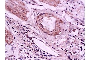 Formalin-fixed and paraffin embedded human gastric carcinoma tissue labeled with Anti-E-Selectin Polyclonal Antibody, Unconjugated (ABIN674244) at 1:200 followed by conjugation to the secondary antibody and DAB staining