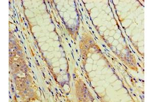 Immunohistochemistry of paraffin-embedded human colon cancer using ABIN7162957 at dilution of 1:100 (EHHADH Antikörper  (AA 1-723))