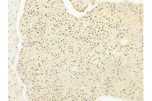 ABIN6260535 and ABIN6279822 at 1/100 staining human esophageal carcinoma by IHC-P. (CCL13 Antikörper  (Internal Region))