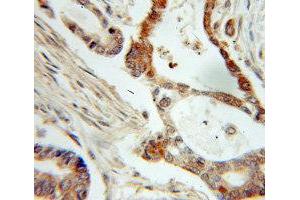 Immunohistochemistry of paraffin-embedded Pancreas cancer using NME1 antibody. (NME1 Antikörper  (C-Term))