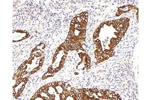 Immunohistochemistry analysis of paraffin-embedded human stomach cancer using CK-8 Polyclonal Antibody at dilution of 1:200. (KRT8 Antikörper)